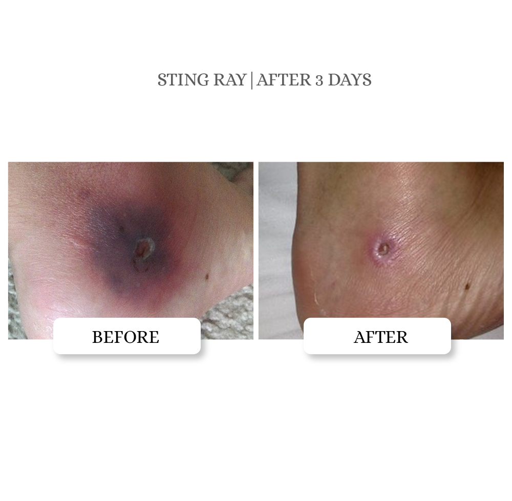 Skin Tag Relief