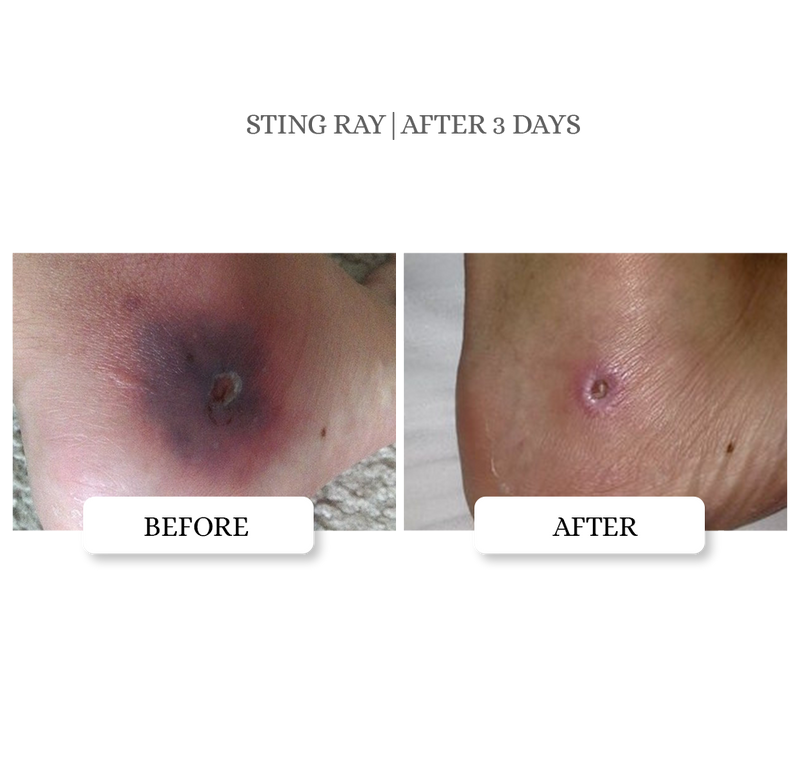 Skin Tag Relief