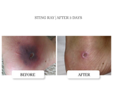 Skin Tag Relief