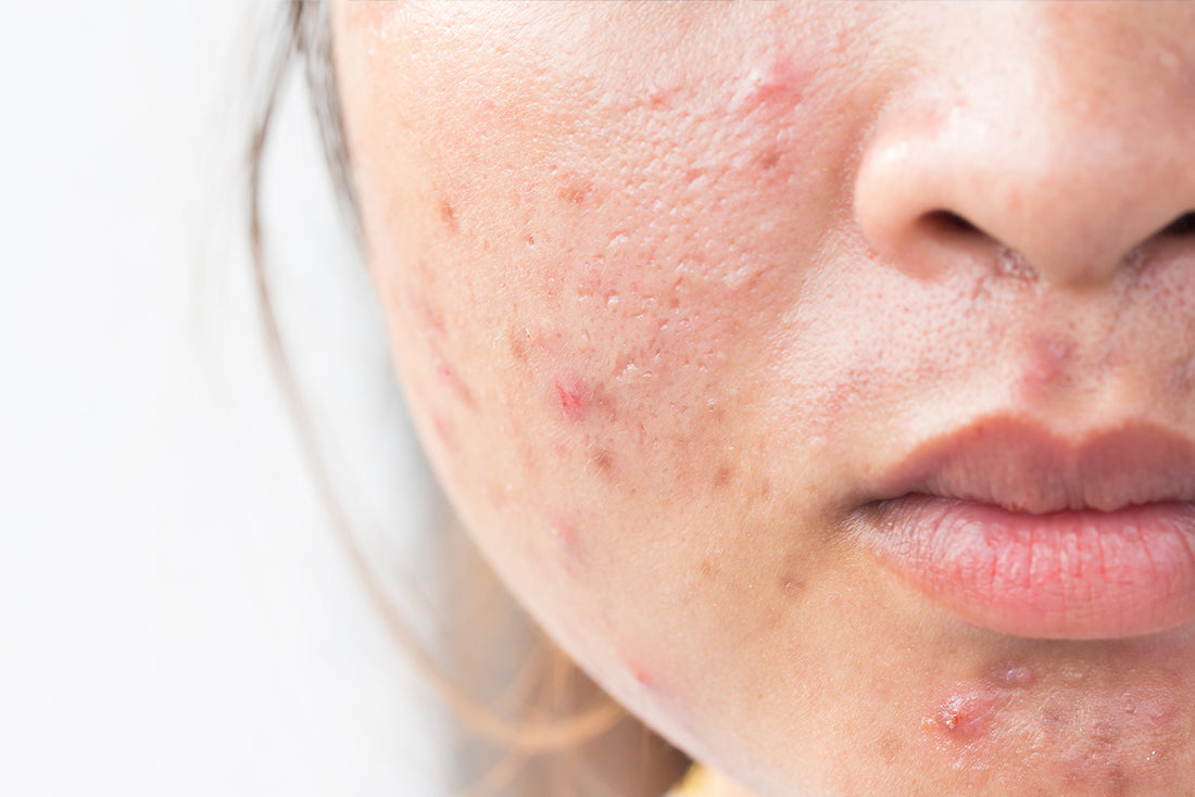 A Holistic Look at Healing Acne